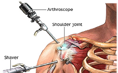 SHOULDER LESIONS & ARTHROSCOPY