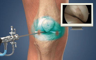 KNEE LESIONS & ARTHROSCOPY