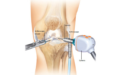 arthroscopy